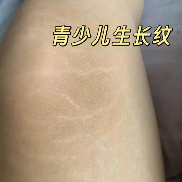 肥胖纹男霜生长纹消除大腿学生的膏祛淡化膨胀纹的膏去修HY