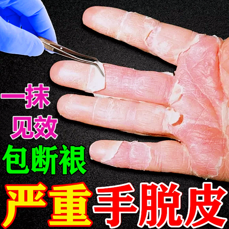 手脱皮严重脱皮专用真菌蜕皮干燥秋冬起皮手脚上感染手足抑菌药膏