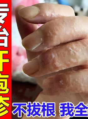 汗包膏专用软膏手上起小水泡止痒手痒脱皮乳膏