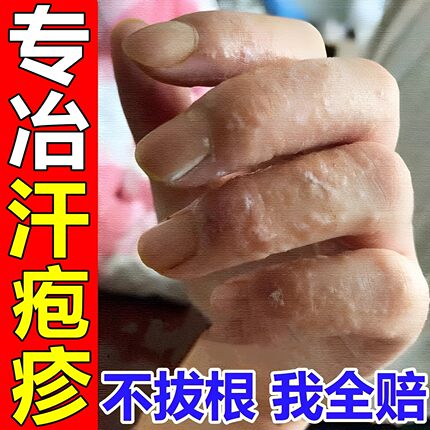 汗泡疱疹药膏手上起小水泡脱皮汗状疱疹止痒汉状真菌感染专用软膏