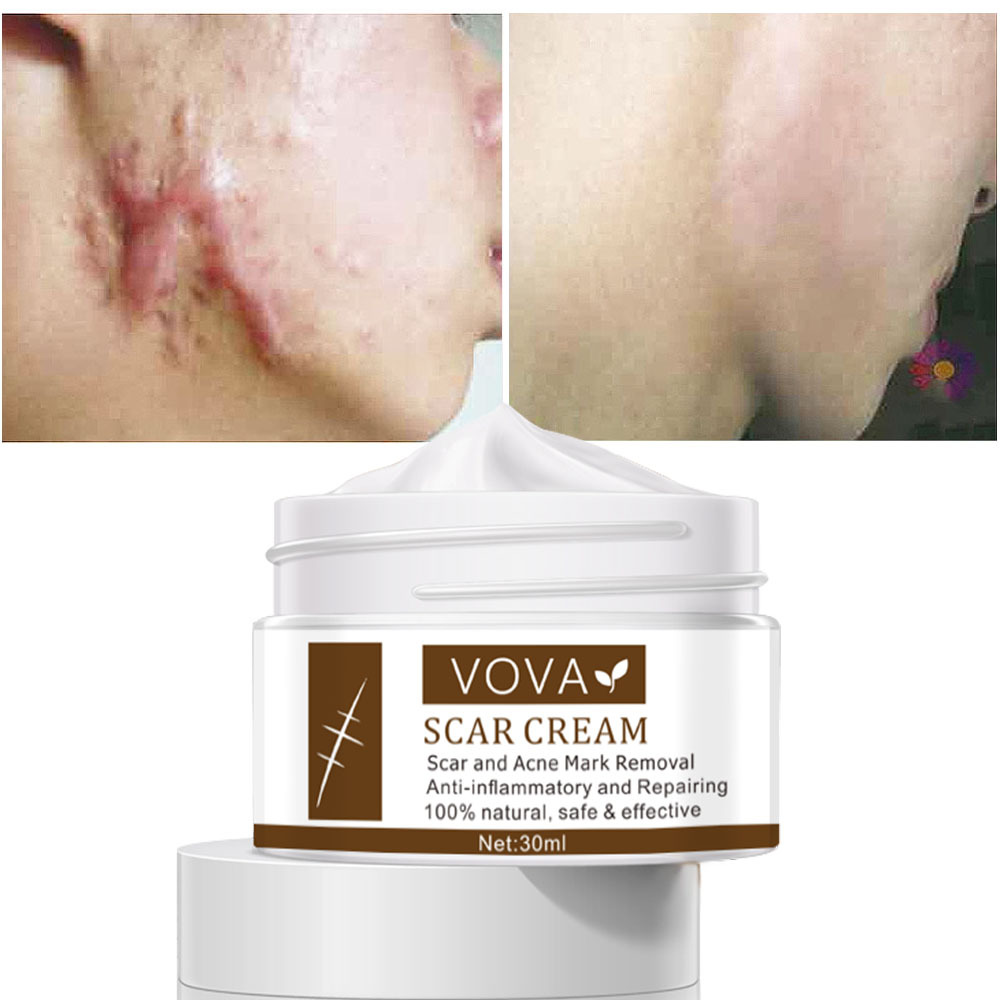 跨境vova Ance Scar  Cream 速卖通 亚马逊护肤品 30ml
