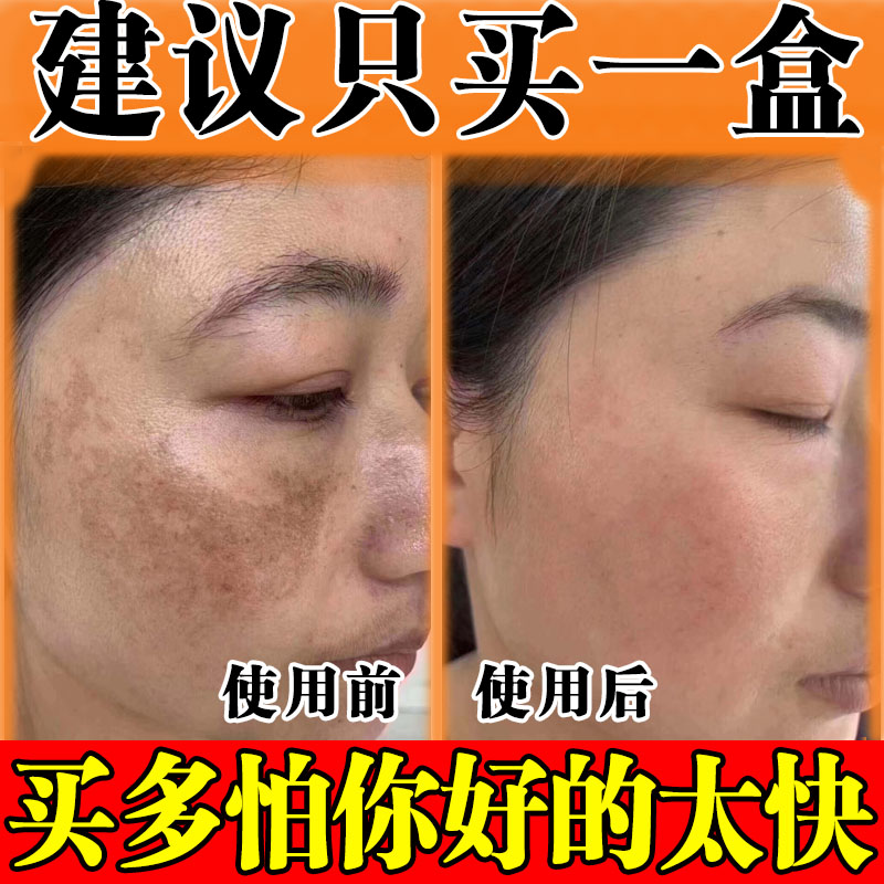 老年斑黄褐斑去除就掉分解黑色素强力手部脸部一擦官方正品精华液