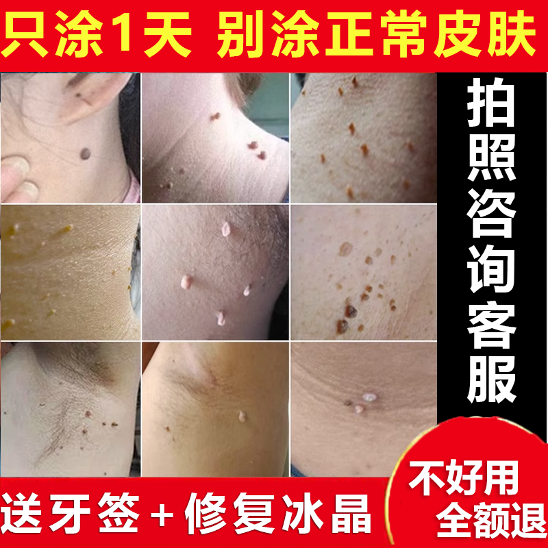 治腋下脖子上的小肉粒疙瘩猴子丝状尤肉球丁去除点腐蚀手脚快速膏