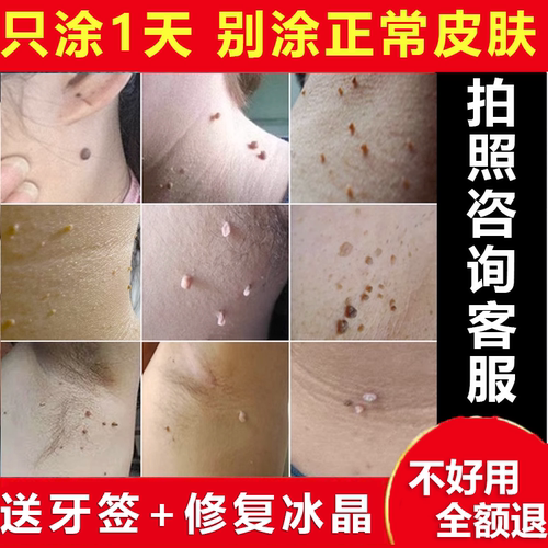 治腋下脖子上的小肉粒疙瘩猴子丝状尤肉球丁去除点腐蚀手脚快速膏