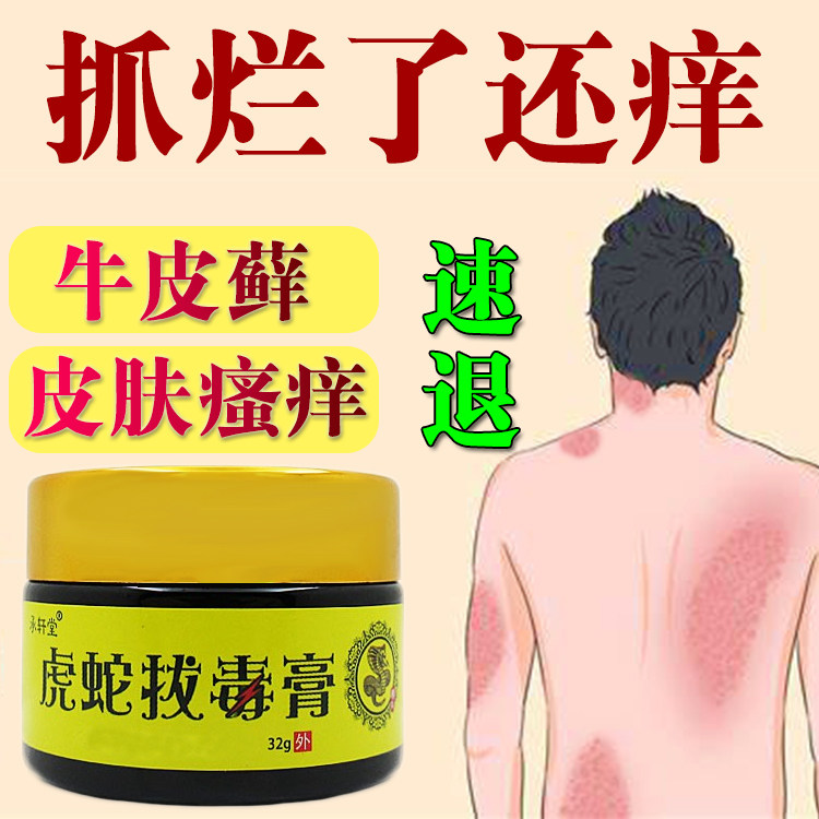 虎蛇拔毒膏去皮藓专用成人皮肤瘙痒身体干痒抑菌止痒膏