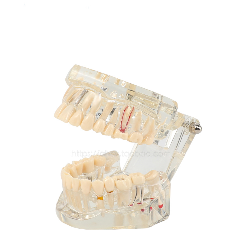 种植修复口腔病理医患沟通牙模