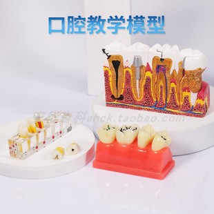 牙齿模型口腔教学牙科口腔摆件窝沟封闭根管展示模型龋齿演变教具