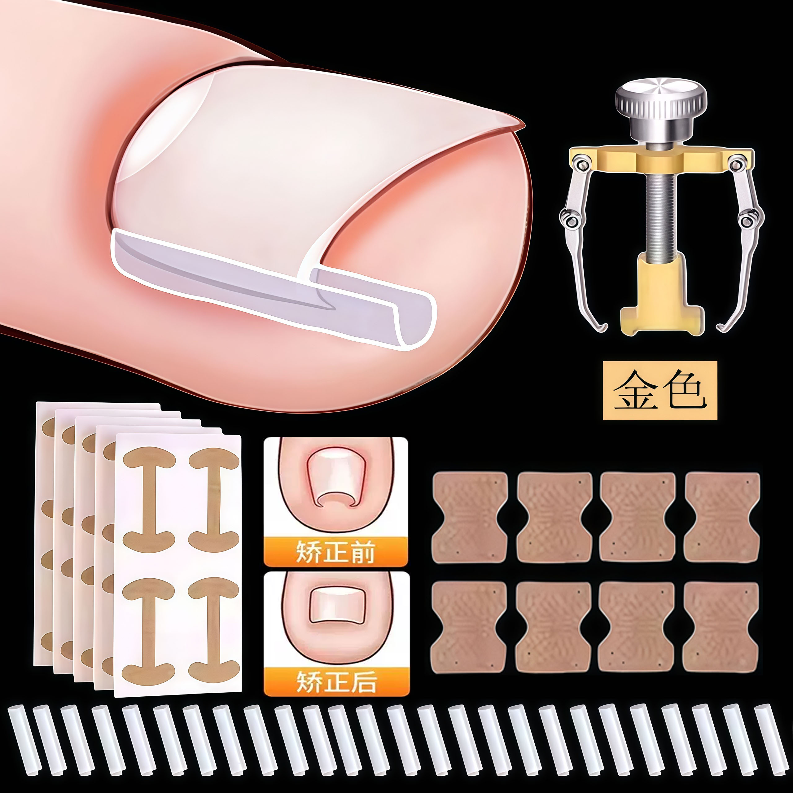 甲沟矫正器嵌甲贴片神器炎阻止趾甲往肉里长专用工具隔离填充垫片