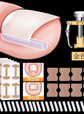 甲沟矫正器嵌甲贴片神器炎阻止趾甲往肉里长专用工具隔离填充垫片
