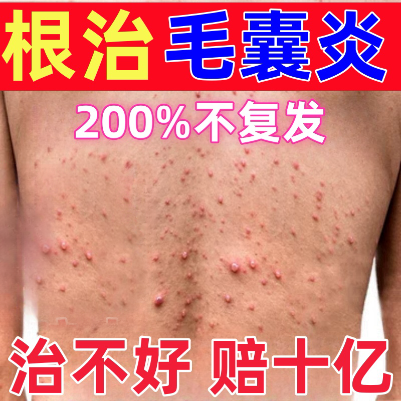 官方推荐/专治毛囊炎一抹全消除