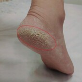 足跟皲裂凝露滚珠脚后跟干裂修复霜膏护脚霜 屈臣氏爆卖