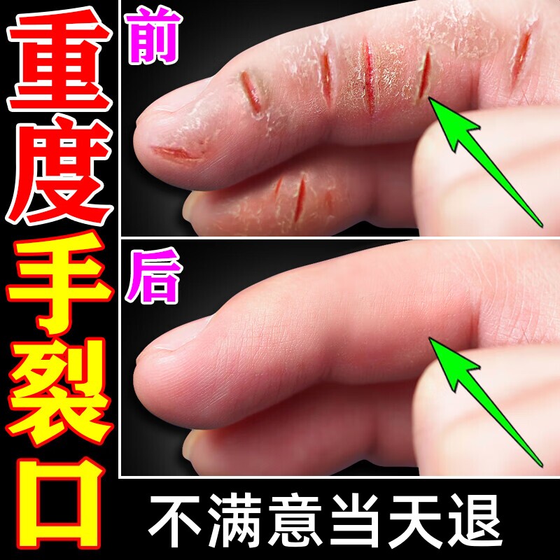 治手指裂口药膏手指严重裂口指甲缝裂口脚后干裂防裂开裂愈合修复