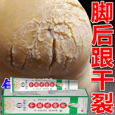 脚裂脚后跟足跟干裂开裂去死皮起硬皮脱皮膏修复霜