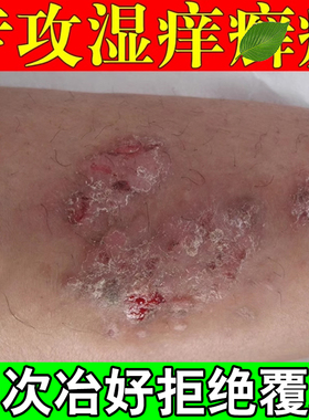神经性皮焱去湿慢性苔后背皮肤膏