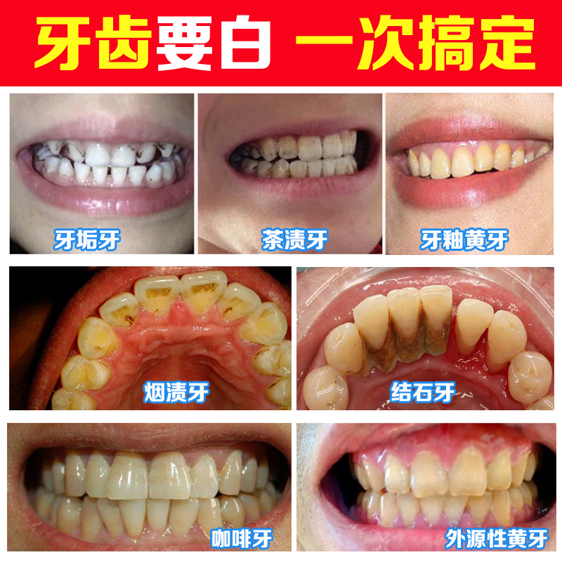 小蘇打牙齒美白潔牙粉去黑去黃洗牙粉黃牙非神器速效去牙垢煙漬