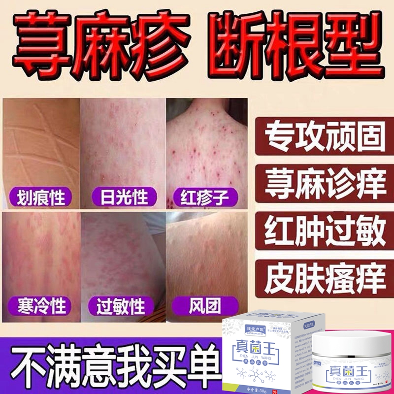 荨麻诊过敏断止痒根专用药膏慢急性治撩皮肤瘙痒寻麻荨疹克星药膏