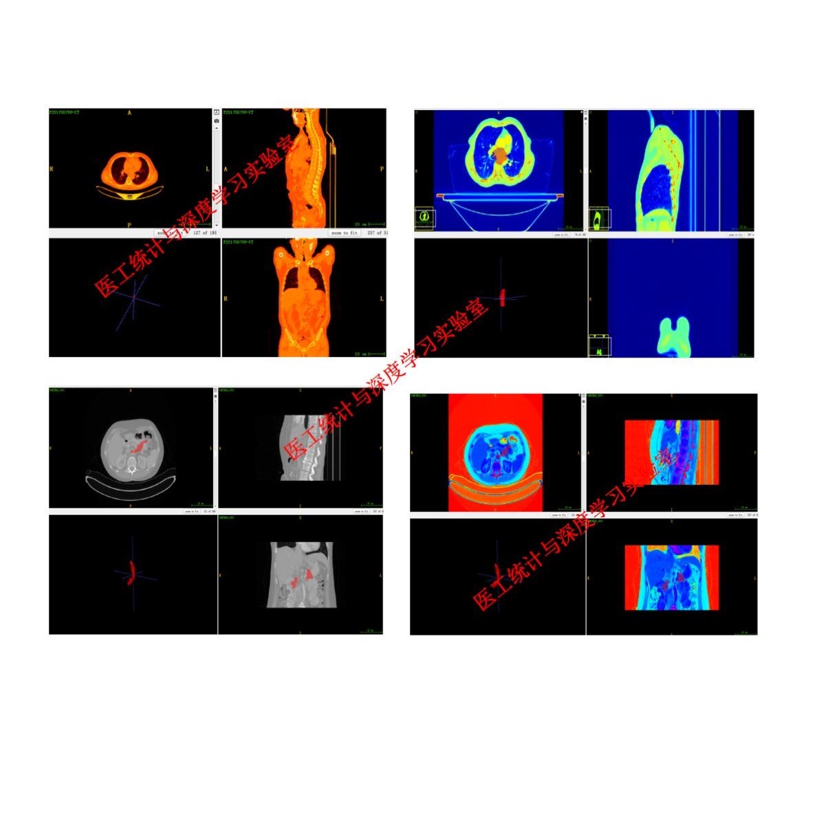 影像组学，数据分析3d图像分割影像组学特征提取深度学习机器学习