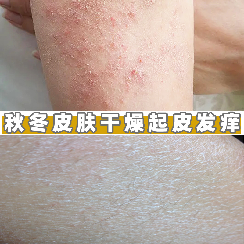 身上起红疙瘩出汗起红点老年人私处皮肤止痒的药草本抑菌止痒软膏