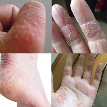 治手足脱皮干裂药水泡痒季节性蜕皮爆皮起水泡痒过敏止痒膏反复药