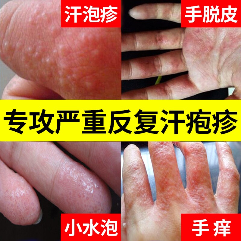 汗疱泡疹专用手上起小水泡鹅掌风软膏药膏带状汉真菌止痒感染正品_虎窝淘