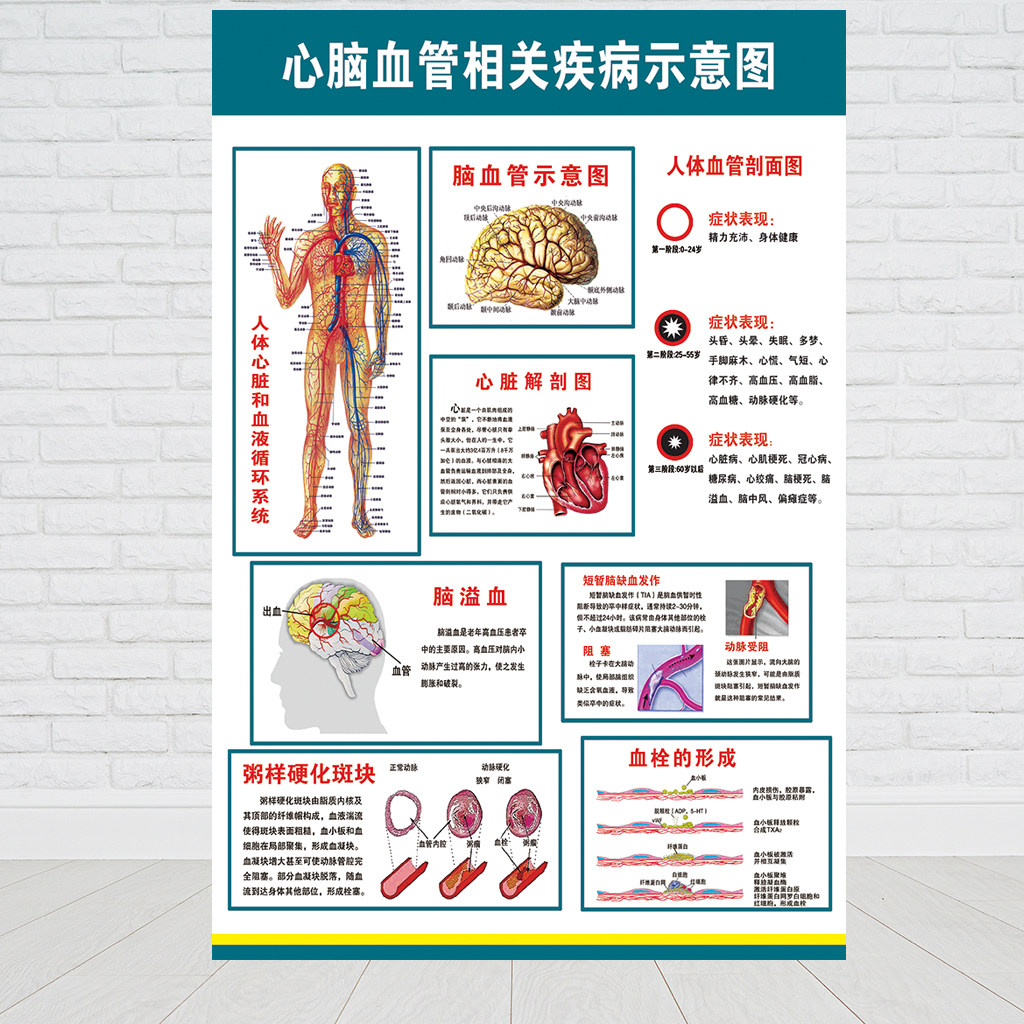 心脑血管相关疾病血栓脑溢血粥样硬化斑块示意图海报医院科室挂图