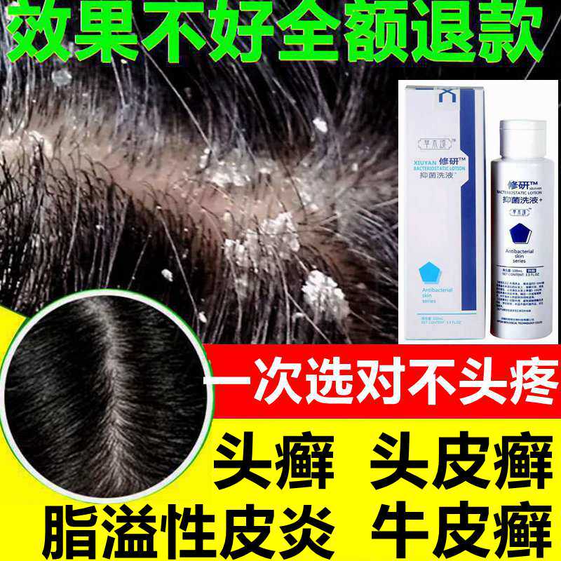 洗发水脂溢性皮炎头部牛皮癣头皮癣治银屑病去屑止痒软膏头皮外用