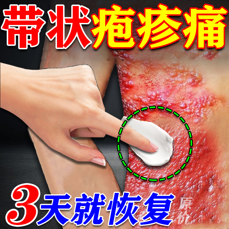 带状疱疹后遗症神经痛效特膏药贴专用根断蛇盘疮缠腰正品外用喷剂