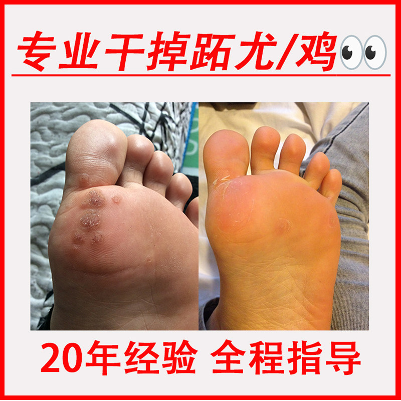 尚发研跖疣瘊膏刺猴猴子肉刺肉粒疙瘩根非神器不去除非药抑菌液