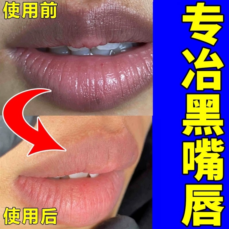 唇周黑改善嘴角暗沉去除黑色素嘴巴周边发黑暗沉唇部护理淡化唇色