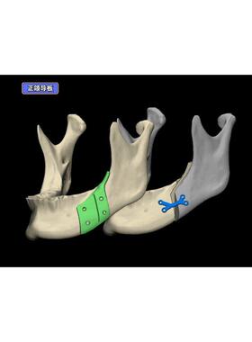 MIMICS医学影像处理CT MRI三维重建模分割生物力学FEA分析代做
