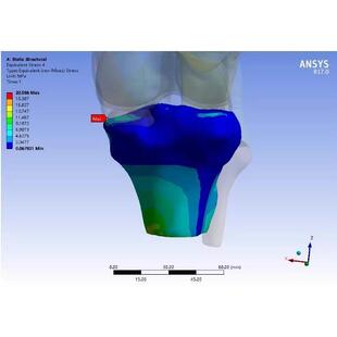 医学有限元分析服务,适用於骨科、口腔等多科三维重建和仿真模拟