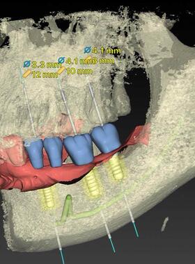 Mimics血管肺肝心脏各器官CT或MRI三维重建3dslicer vtk itk代做