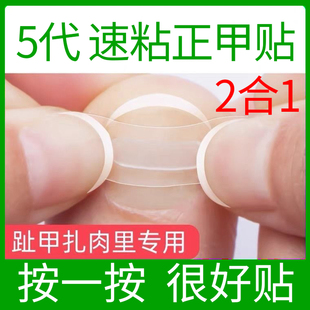 速粘正甲贴脚趾甲专用甲沟矫正贴指甲长肉里嵌甲炎矫正器套装