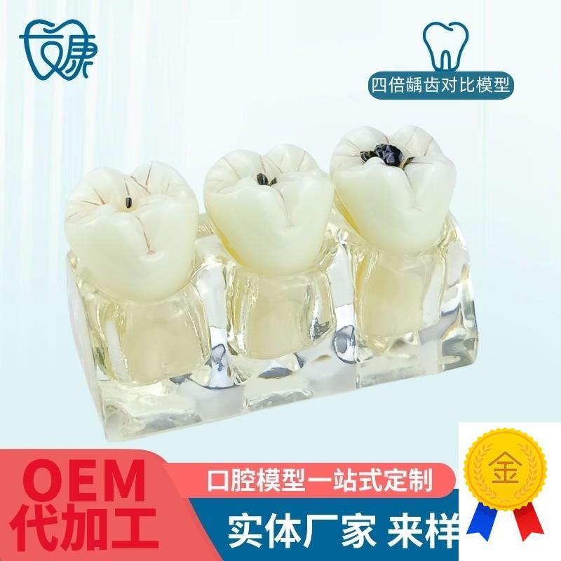 牙模型牙科口腔教学模s型窝沟封闭模型龋齿对比模型龋齿模型