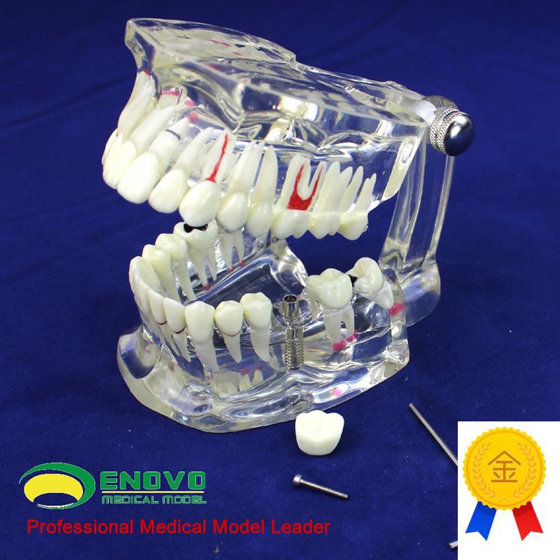 ENOVO颐诺牙齿模型口t腔牙齿科种植模型口腔病理模型种植体牙冠义