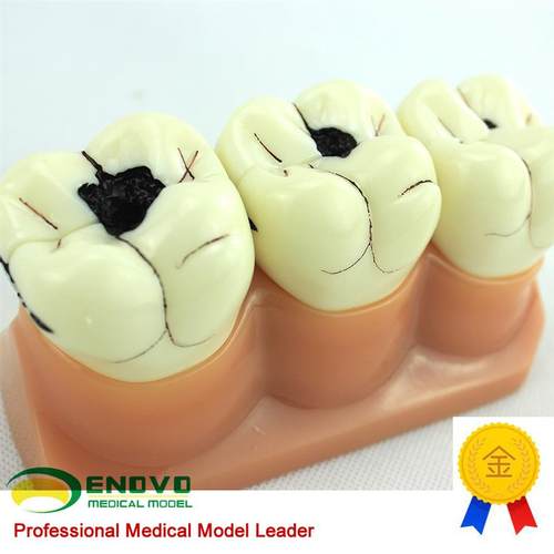 ENOVO颐诺口腔科牙齿龋齿w模型儿童虫牙蛀牙模型口腔健康儿童病理