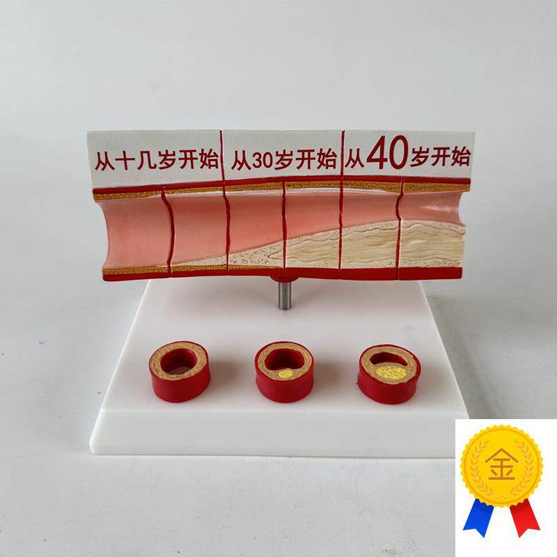 心脑血管堵塞模型关节血栓血液浓度脂肪病理O粥样硬化人体解剖教