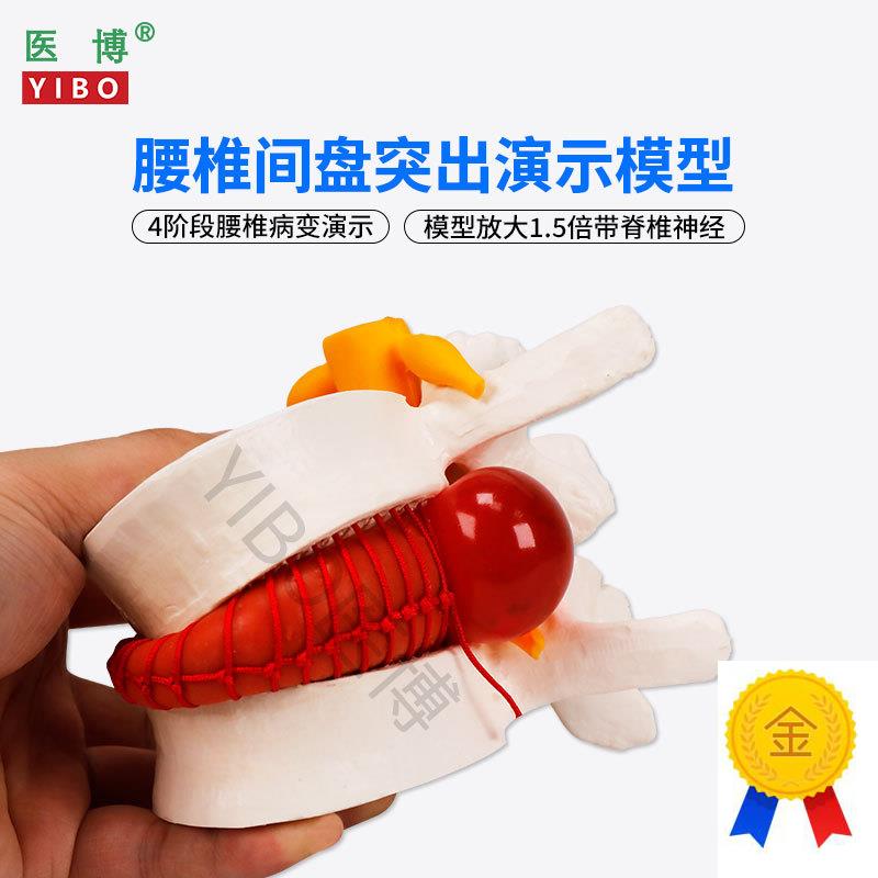 医博BIX-A3561人体腰椎间盘突出病变演示模型人体脊柱腰椎模型人