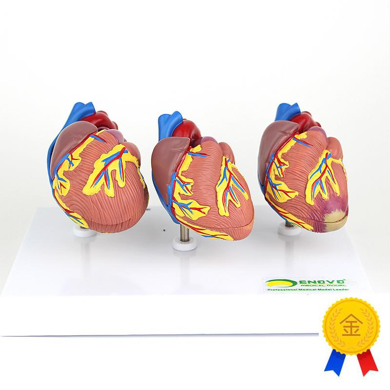 ENOVaO颐诺心脏病演示模型心血管系统心肌梗死充血性心力衰竭心