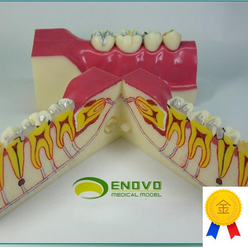 ENOVO颐诺右下后牙组织分解模型E牙齿解剖牙列模型口腔齿科科教学