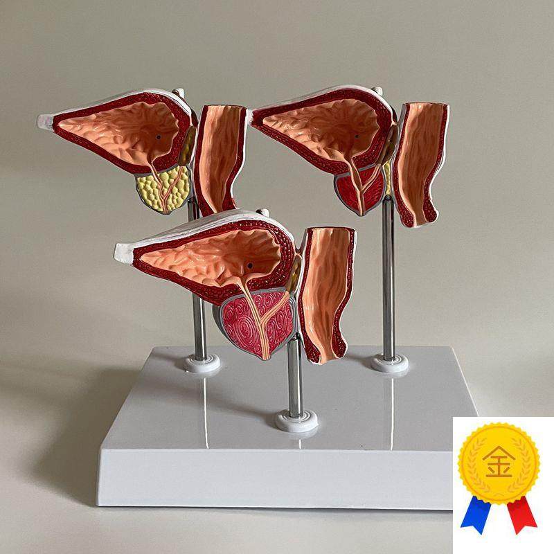 康泰医学模型f前列腺健康病变增大生尿道狭窄男科医药促销生殖膀