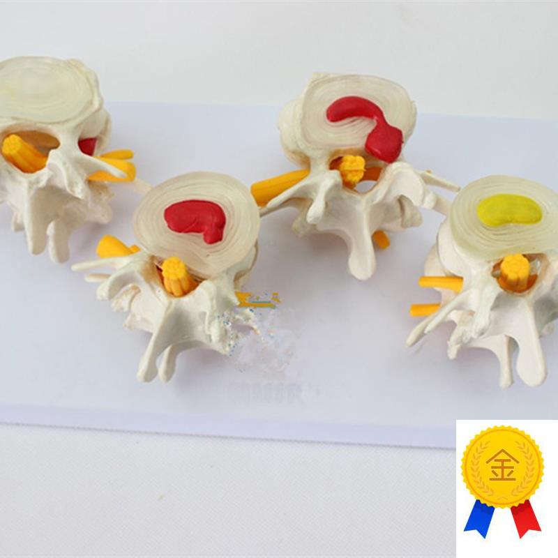 4阶段病态腰椎比较模型人体四个D时期病变腰部脊柱脊椎模具标本