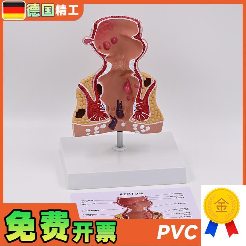 德国】新款大促爆款人体模型肠直肠解剖病理模Q型病态疾病教具模