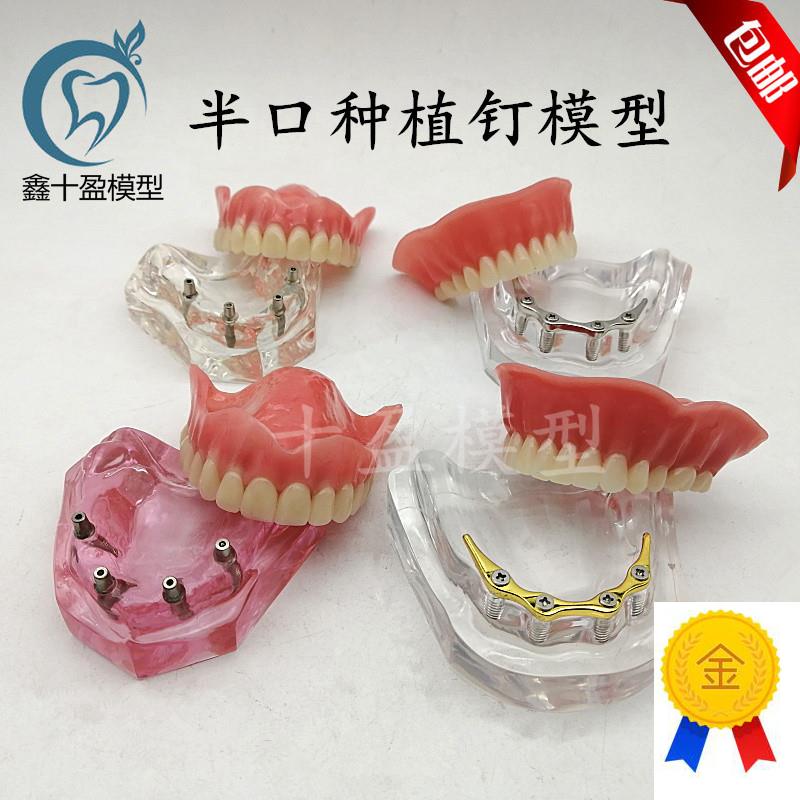 牙科模型医患沟通2四4颗钉y种植与修复模型种植钉球帽杆卡导板