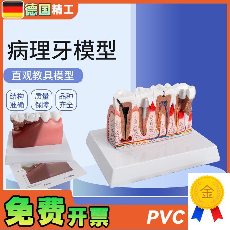 德国】病理牙模型成人病理牙齿模E型口腔模型牙科教学模型演示模