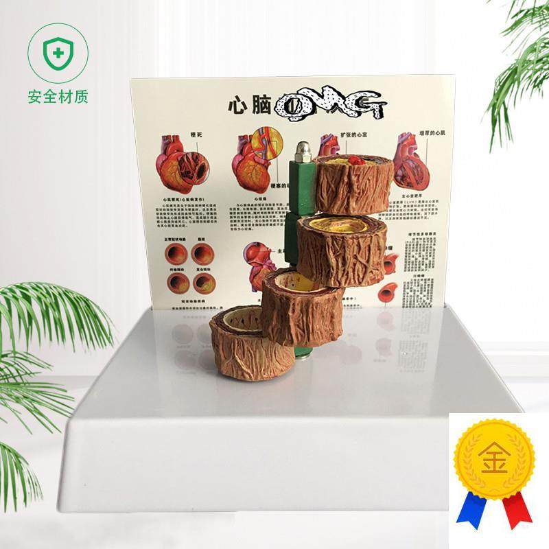 动脉粥样a硬化模型血栓病变模型血管病演示心脏模型血管病理