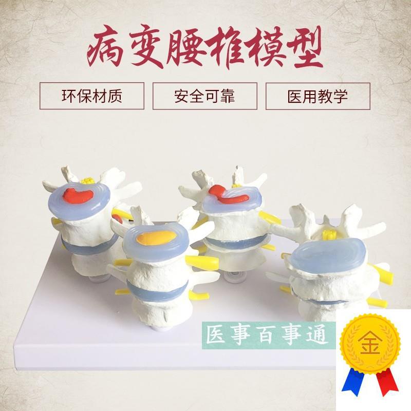 四分型脊椎正常与病变腰椎组合模型F椎间盘腰椎病理过程病变演示