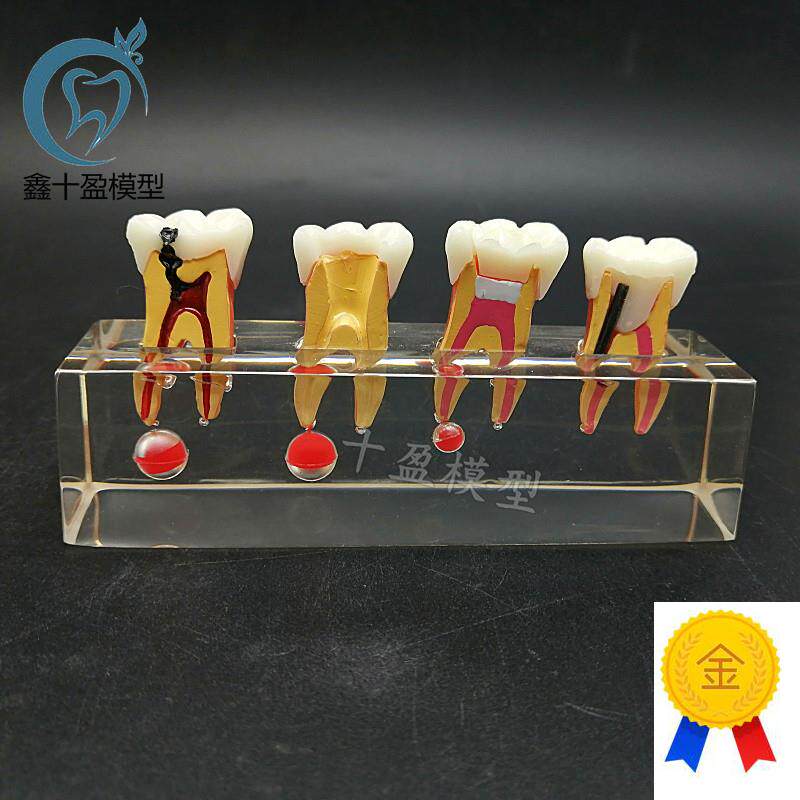 牙科教学b模型乳牙龋病模型可拆分牙髓修复医患沟通M4018包邮