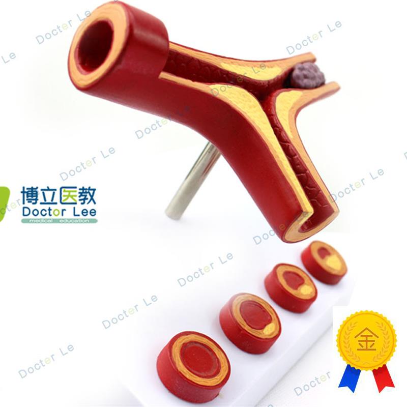 人体支脉粥样化和血全形成模型血管模型R人体血管解剖模型