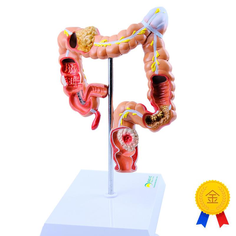 ENOVcO颐诺人体大肠疾病展示模型结肠直肠道病变症状消化系统疾病
